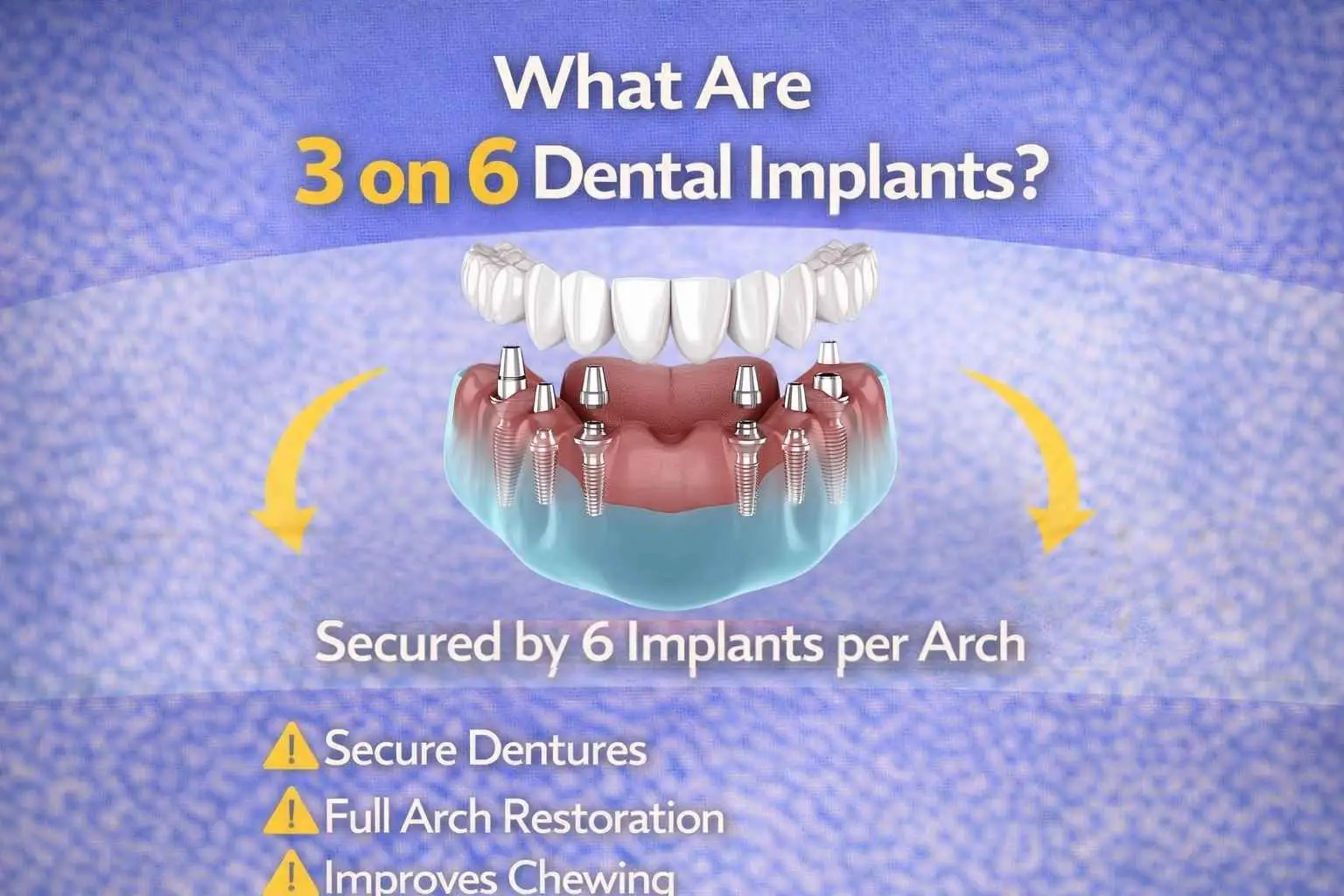 Illustration showing a full arch of teeth secured with six dental implants explaining how 3 on 6 dental implants work
