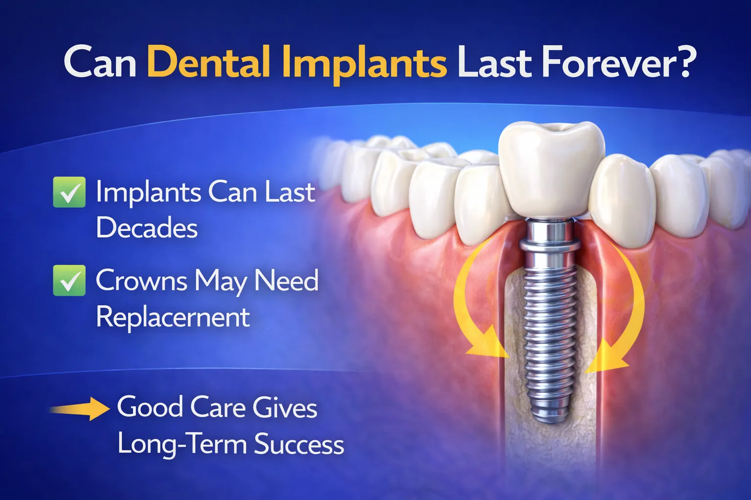 highlighting the longevity of implants and the need for crown replacements, with a detailed dental implant image and key benefits.